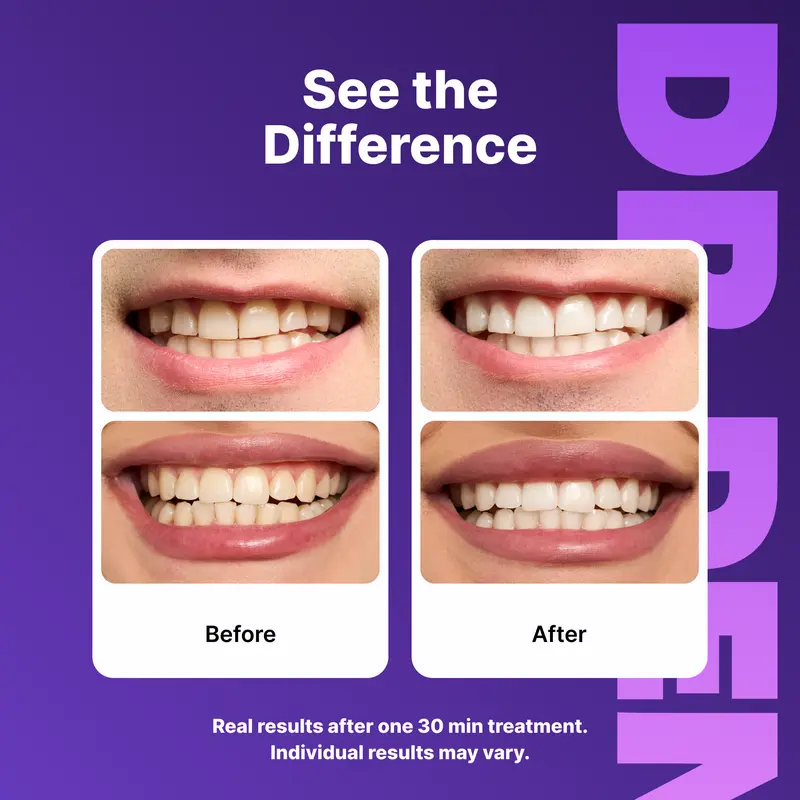 DRDENT Purple Teeth Whitening Strips – Peroxide-Free Whitening for Yellow Stains & Brighter Smile