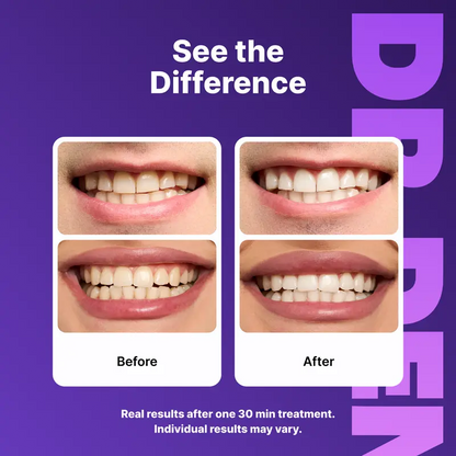 DRDENT Purple Teeth Whitening Strips – Peroxide-Free Whitening for Yellow Stains & Brighter Smile