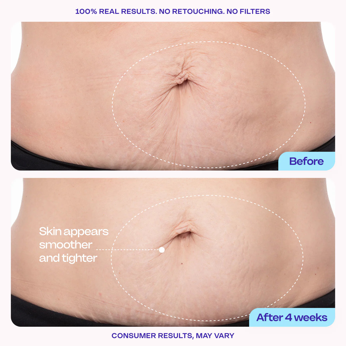 🎁Last Day Promotion 35% OFF🔥Tighten & Smooth Belly Cream