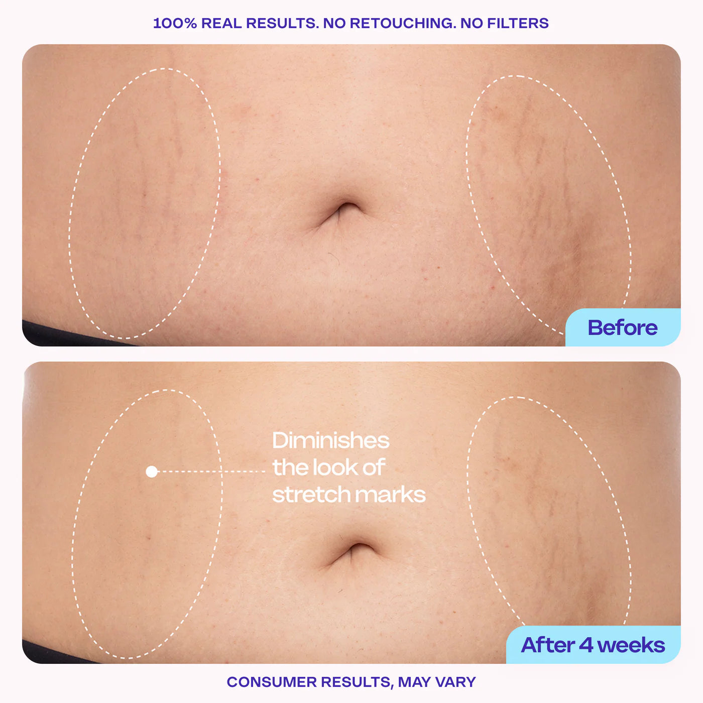 🎁Last Day Promotion 35% OFF🔥Tighten & Smooth Belly Cream